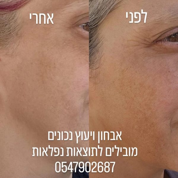 לפני אחרי שימוש בערכת הבהרה