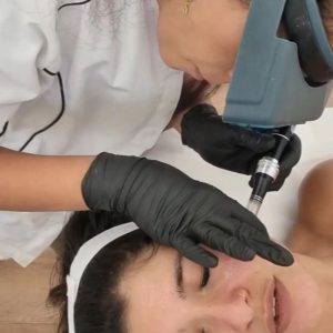 טיפול מיקרונידלינג משולב ננו מטריקס מורן צדק