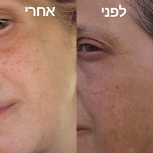 לפני אחרי טיפול הבהרה
