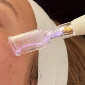 טיפולי פלזמה