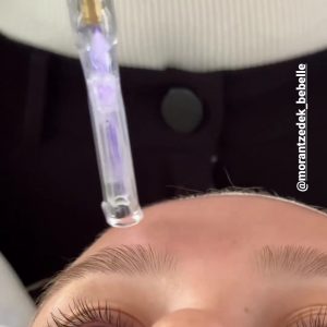 טיפול פלזמה קרה לפיגמנטציה