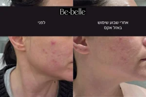 לקוחה מצלמת תמונות לפני ואחרי שבוע של שימוש באזל אקס. בתמונה ניתן לראות שיפור משמעותי בסימני אקנה.